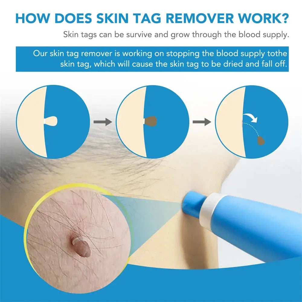 2 IN 1 Auto Micro Skin Tag Remover Device Standard And Micro Skin Tag Removal Kit Adult Mole Wart Remover Face Care Beauty Tools Diymore Global Store